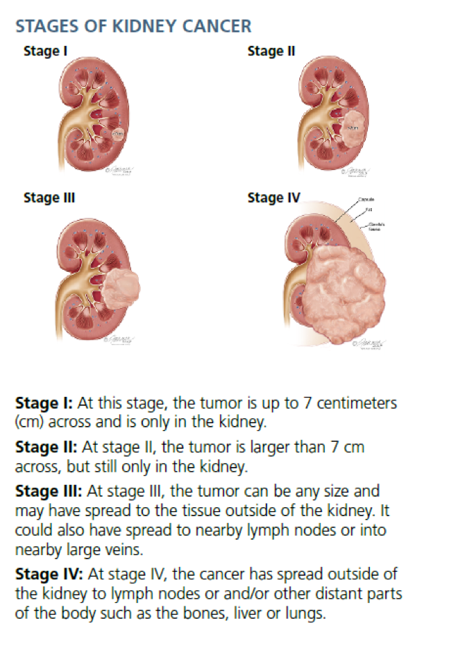 7 Cm Kidney Tumor Size Chart